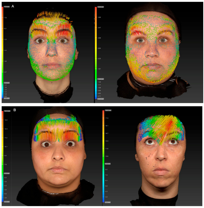 Original research Figure 1 comparing bidirectional and unidirectional forehead skin displacement, with arrows and color scale